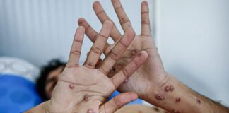 Reportan 77 casos de Viruela del Mono en Perú